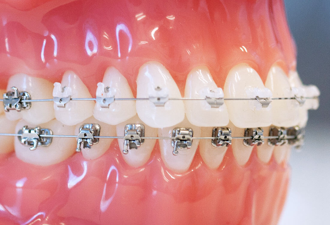 Moonee Ponds Orthodontics  Are Clear or Metal Braces Better?