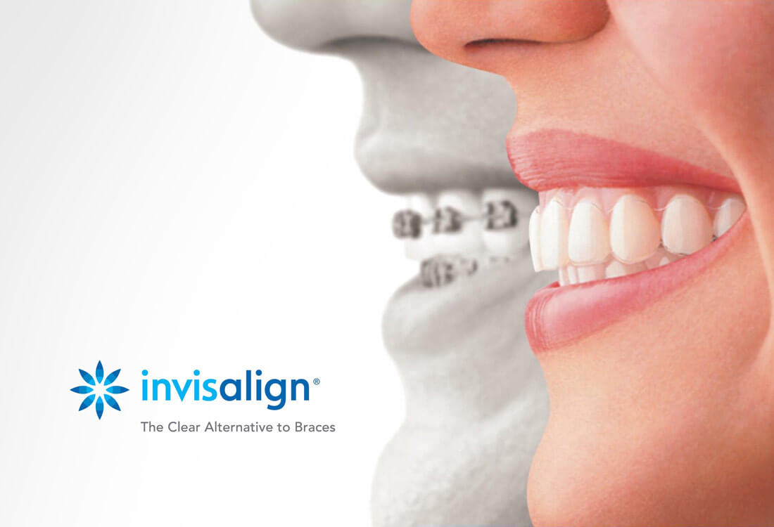 Invisalign